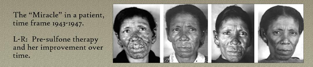 Before and After Sulphone Drug Treatment.
Image Courtesy of the National Hansen's Disease Museum, Permanent Collection. Carville, LA.