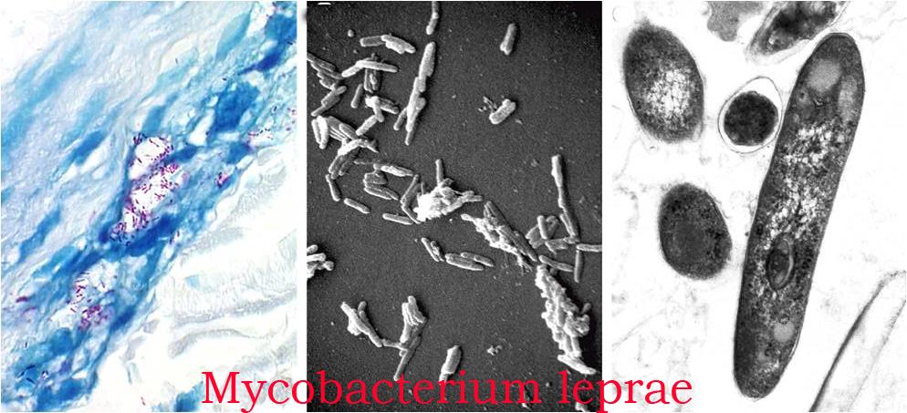 Mycobacterium Leprae.
Image Courtesy of the National Hansen's Disease Museum, Permanent Collection. Carville, LA.